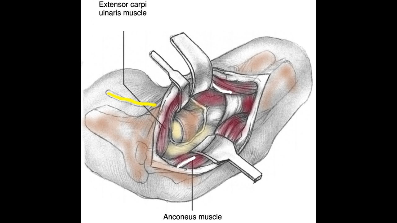 Radial Neck Fractures (Open Reduction and Internal Fixation)