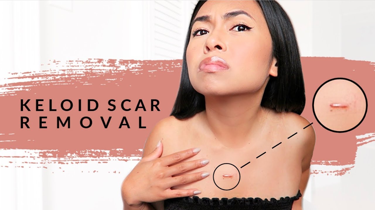 KELOID SCAR REMOVAL (PART 1) - STEROID INJECTION (NO SURGERY) @JulieAbcede