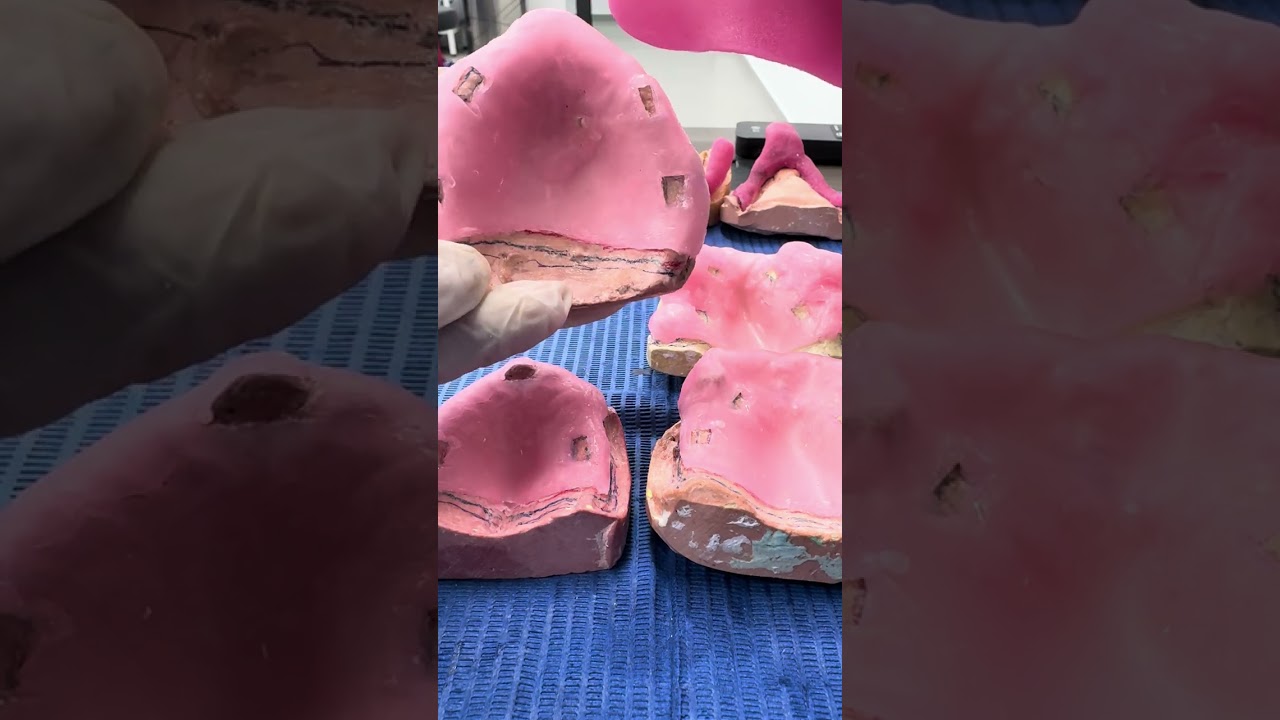 Inicio de elaboración de cucharillas individuales superiores de pacientes reales 