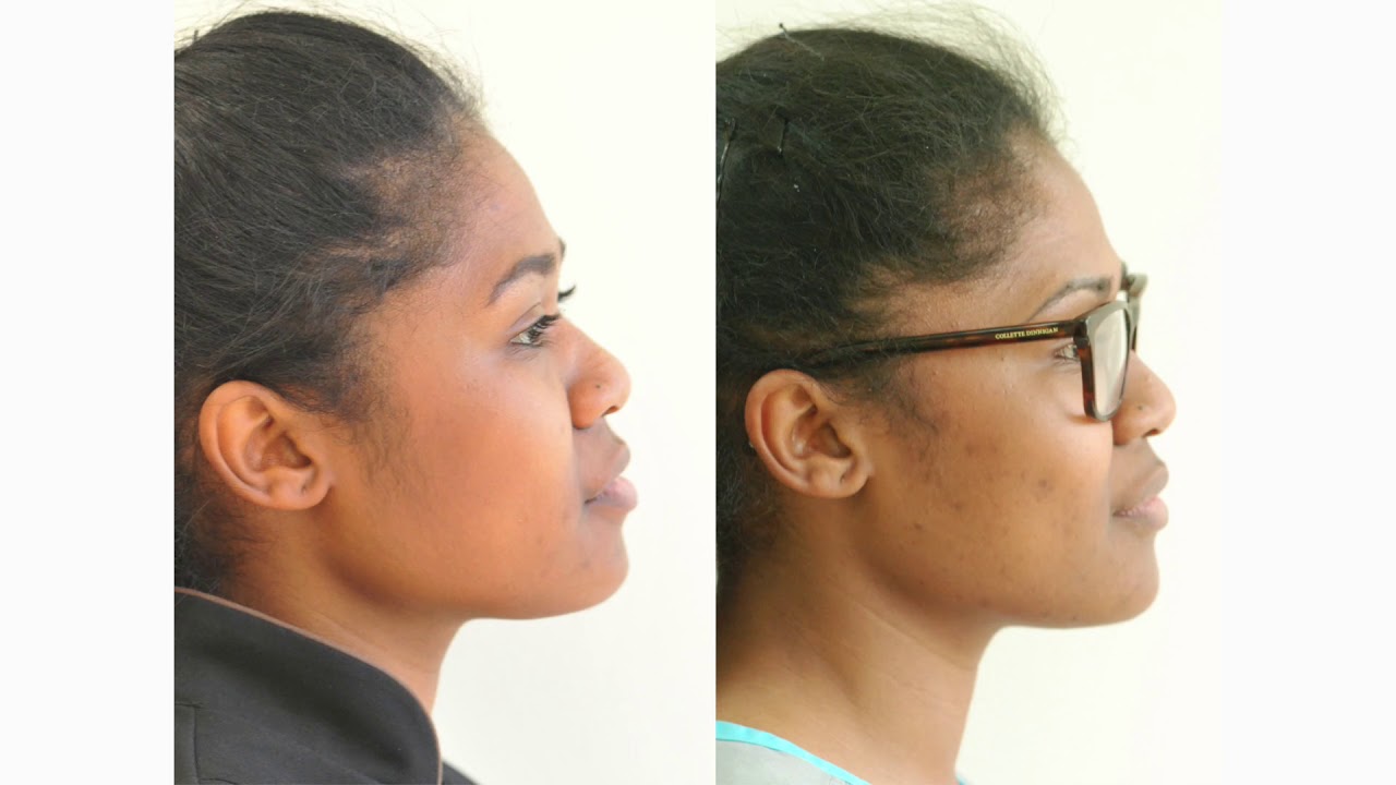 How Orthodontic Extractions can change Facial Profiles