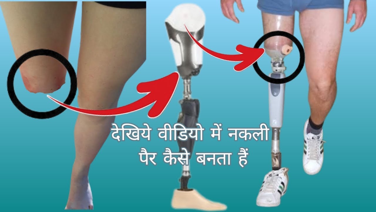 नि: शुल्क में बनवाइये  नकली पैर, हाथ  कृत्रिम Body  Parts