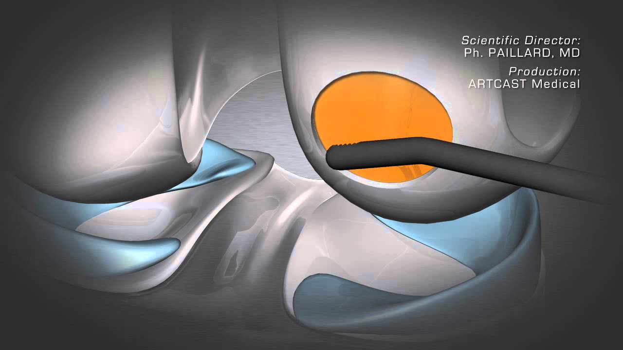 Knee Cartilage Damage