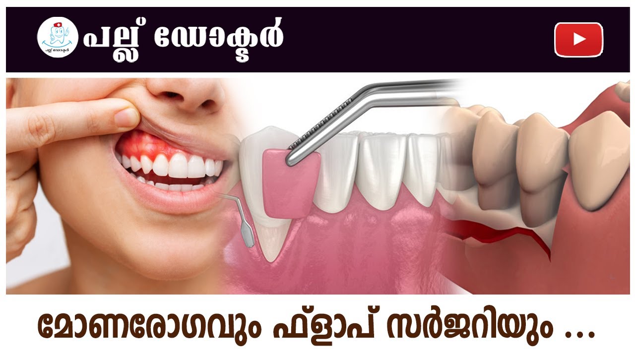 മോണരോഗവും ഫ്ലാപ് സർജറിയും/Understanding Gum Disease and Flap Surgery: Causes, Treatment and Recovery