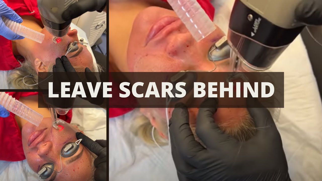 LEAVE SCARS BEHIND WITH LUTRONIC CO2 | Dr. Jason Emer
