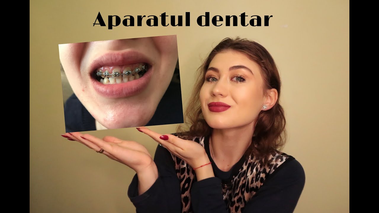 VLOGMAS 17🤓 EXPERIENȚA MEA CU APARATUL DENTAR- costuri, probleme, dureri și întâmplări amuzante.