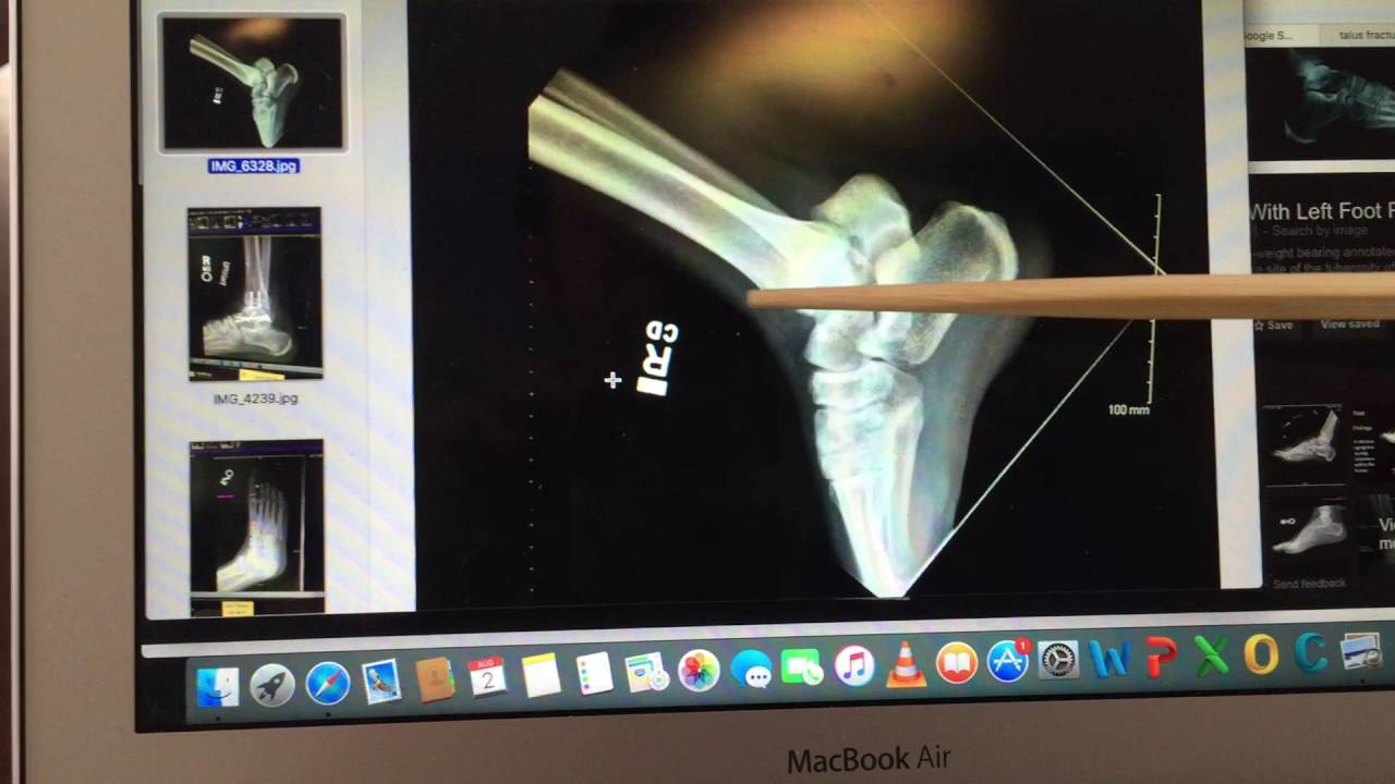 Part 1: Talus Fracture hawkins 3 displaced fracture explained, x-rays