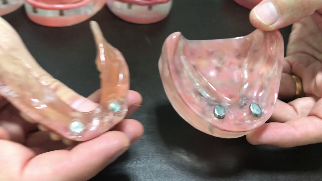 5 tipos de prótese dentária: da fixa ao imã
