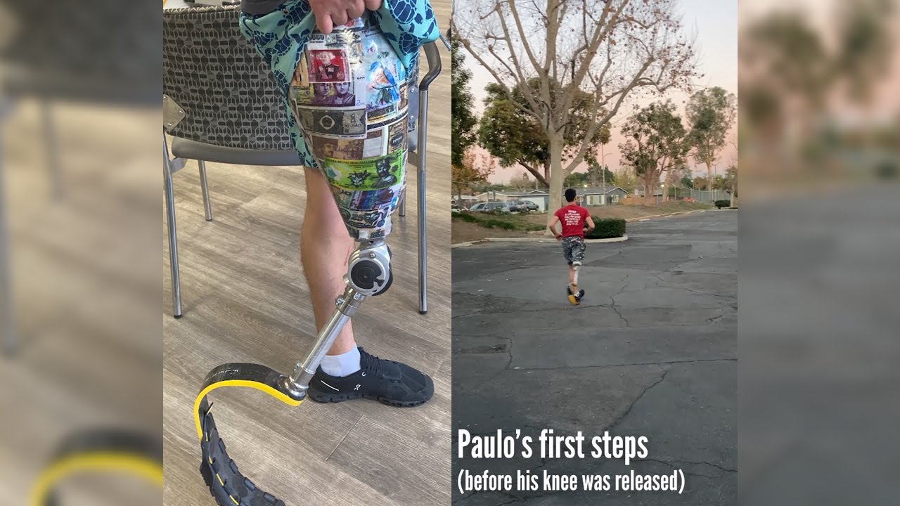 Above Knee Amputee Runs for the First Time in 7 Years!