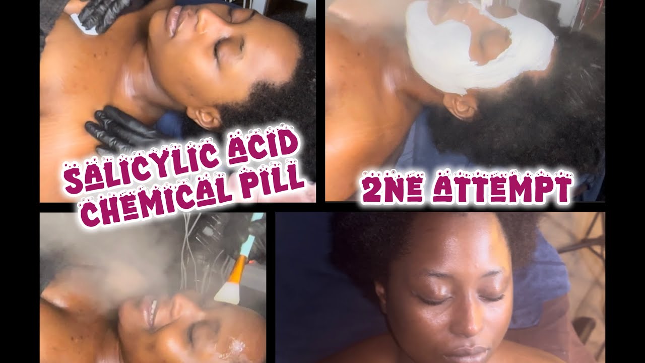 Chemical Peel| Ft￼ salicylic acid peel| 2nd attempt on sensitive skin 
