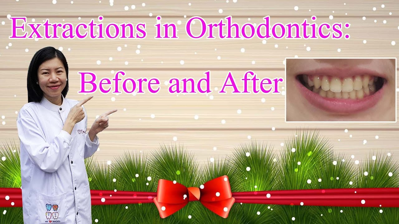 Extractions in Orthodontics: Before and After