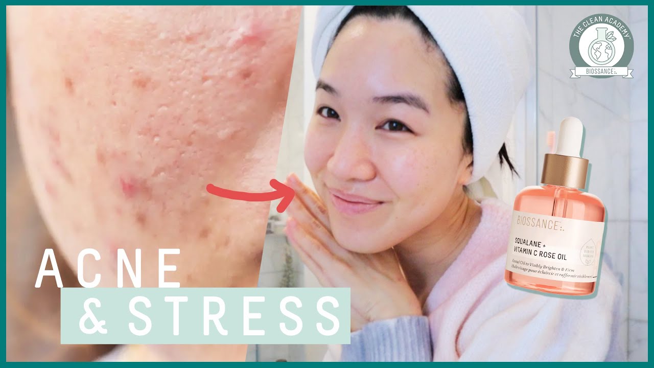 Beauty Within Uncovers How Stress Affects Acne | The Clean Academy