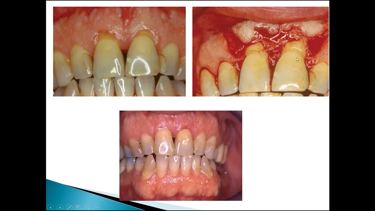 Periodontal flap   Dr Enas Elgendy