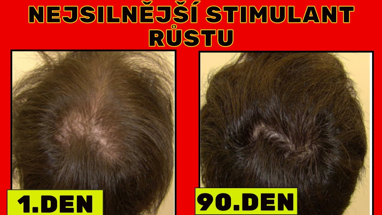 NEJSILNĚJŠÍ STIMULANT RŮSTU VLASŮ