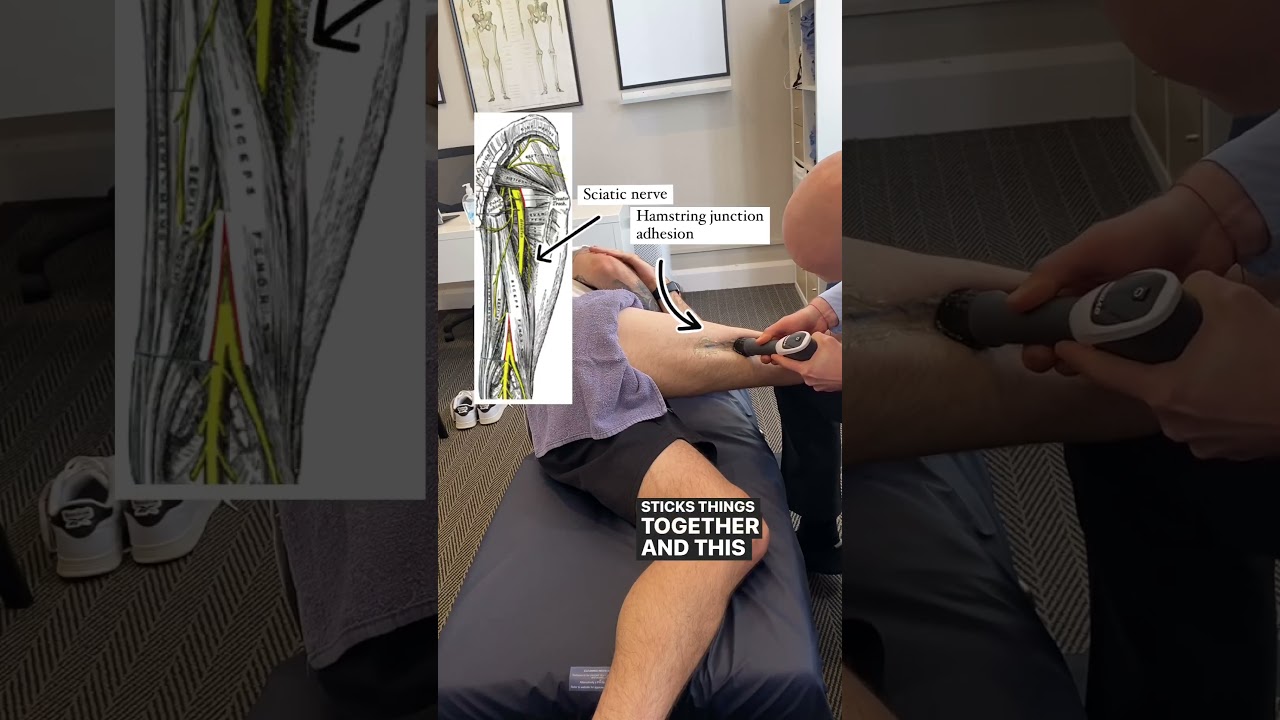 Treatment for TIGHT HAMSTRINGS when stretching doesn't help