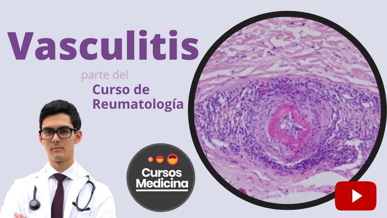 Vasculitis - Curso de Reumatología
