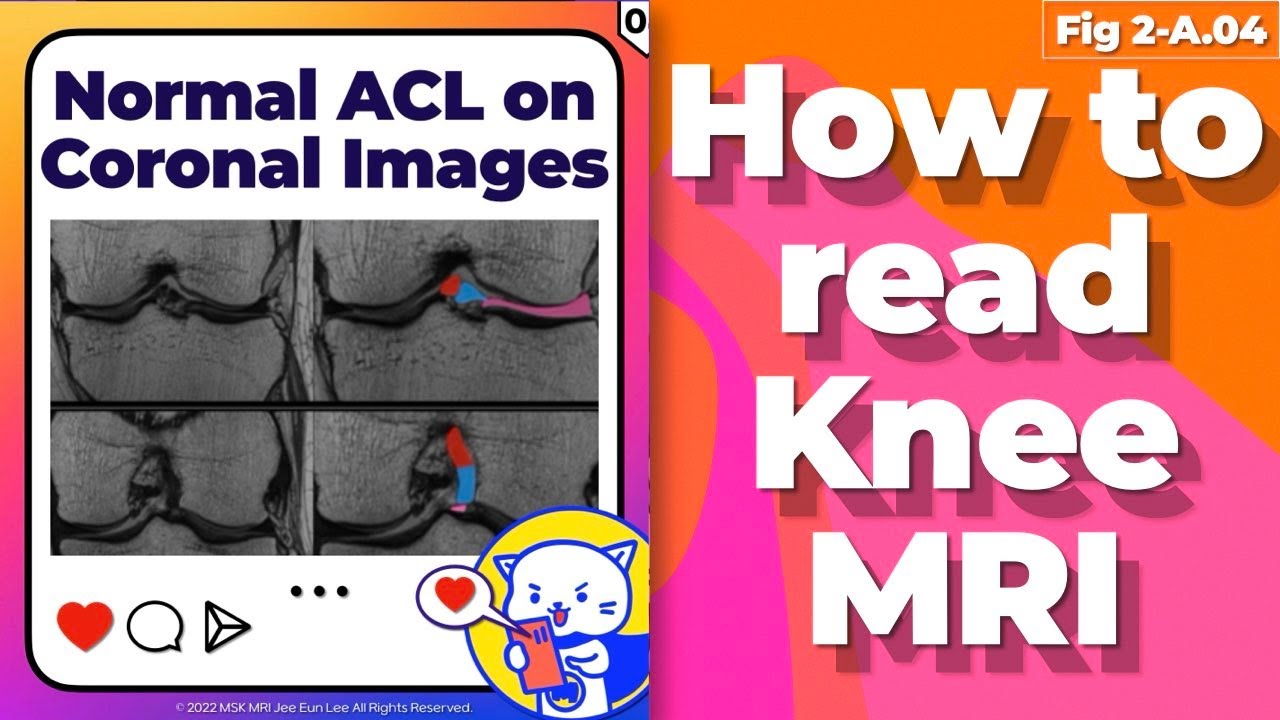 (Fig 2-A.04) Normal ACL on coronal images, anteromedial and posterolateral bundles of ACL