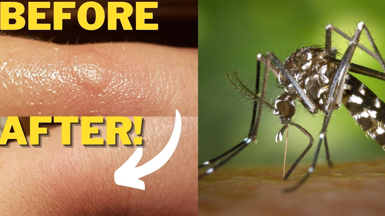 Easy DIY mosquito (bug) bite relief ointment/salve