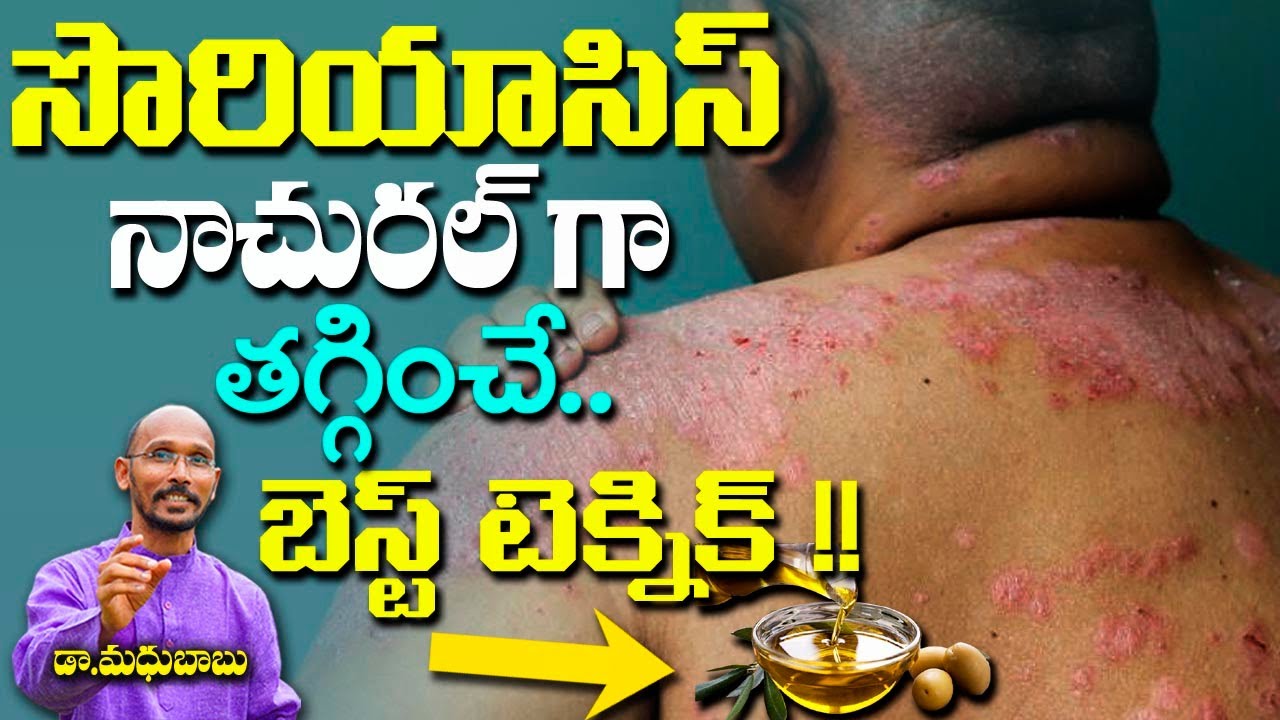 సోరియాసిస్ నాచురల్ గా తగ్గించే బెస్ట్ టెక్నిక్ !! | Dr. Madhu Babu | Health Trends |