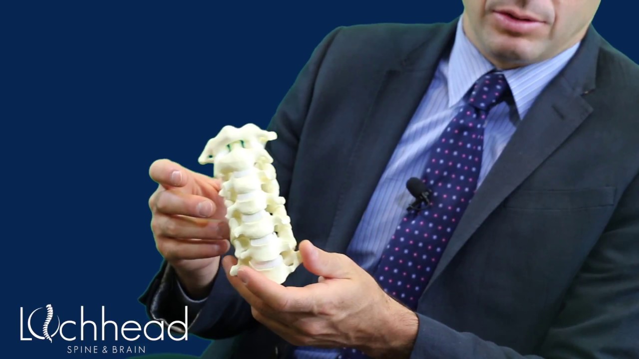 How Much Motion Will I Lose After Cervical Fusion Surgery?