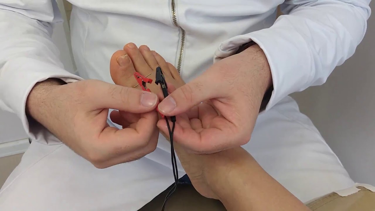 Eletroacupuntura para analgesia