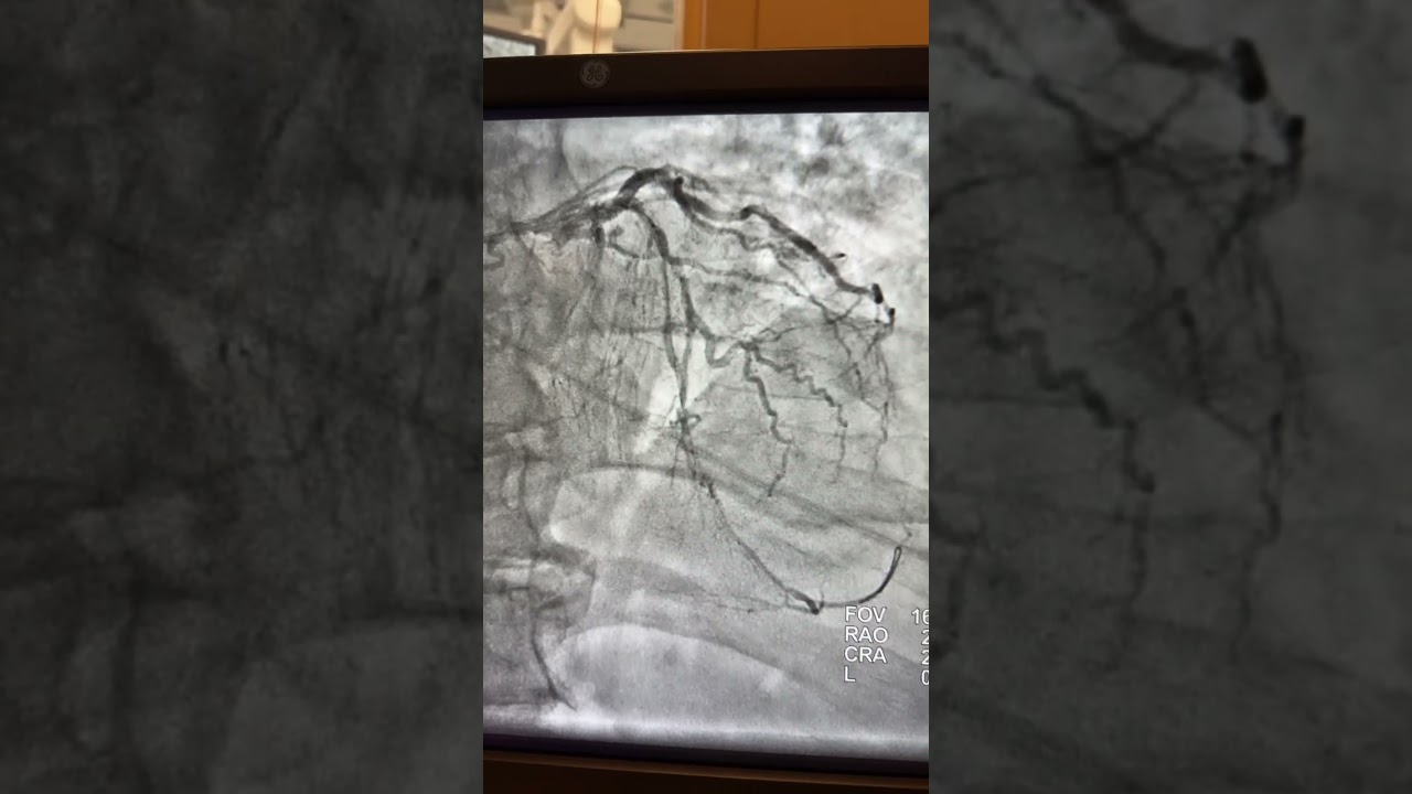 CTO-LAD, Chronic Total Occlusion, when the bypass surgery is not an option! Successful PCI.!