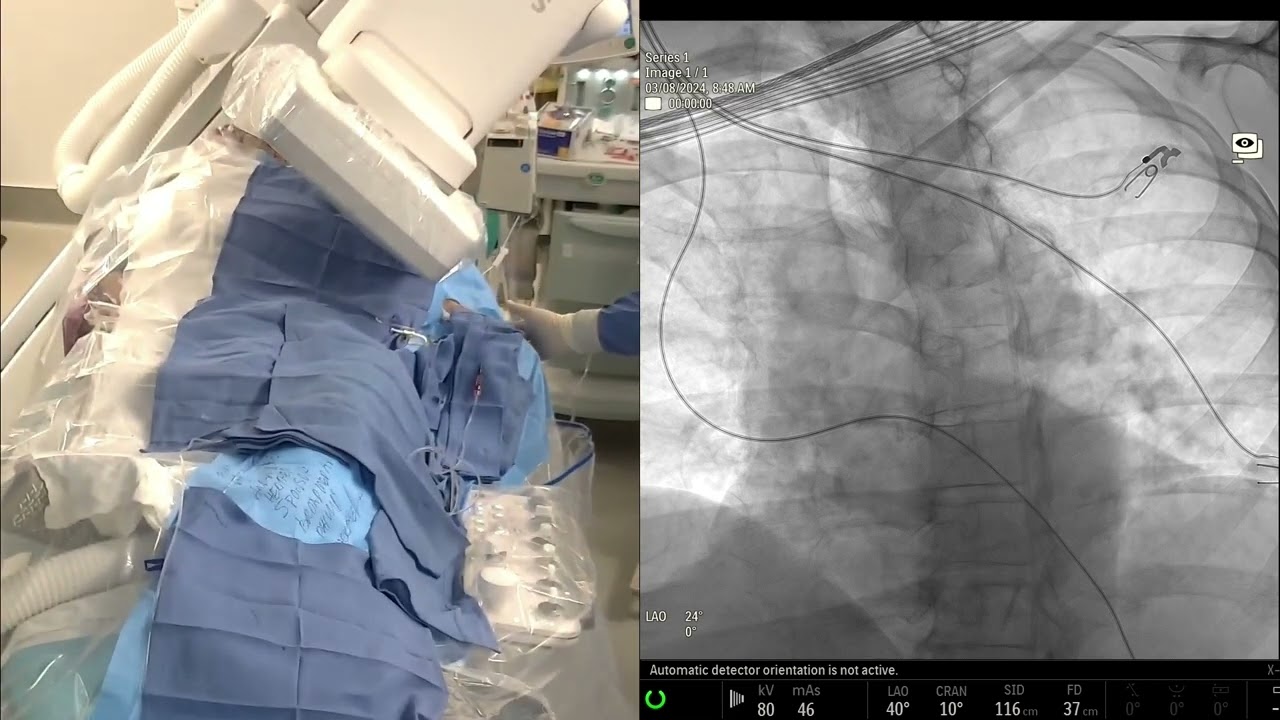 Watch Live Prostate Artery Embolization using N-BCA Glue