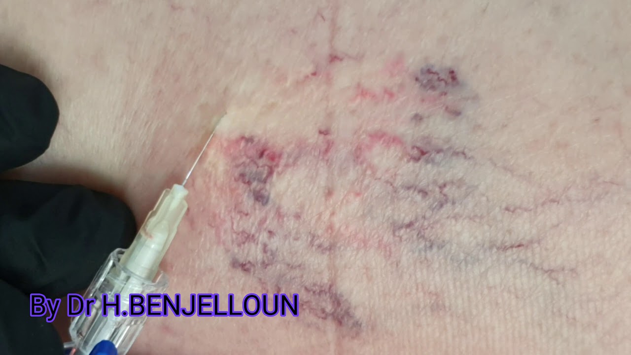 Comment traiter les varices? Sclerotherapie des  varicosit&eacute;s /علاج دوالي العنكبوتية بالتصليب و الحقن