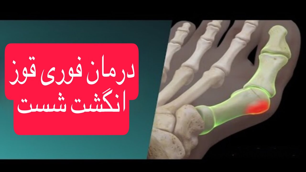 درمان فوری قوز انگشت پا(درمان هالوکس والگوس)ودرمان آرتروز انگشت شست