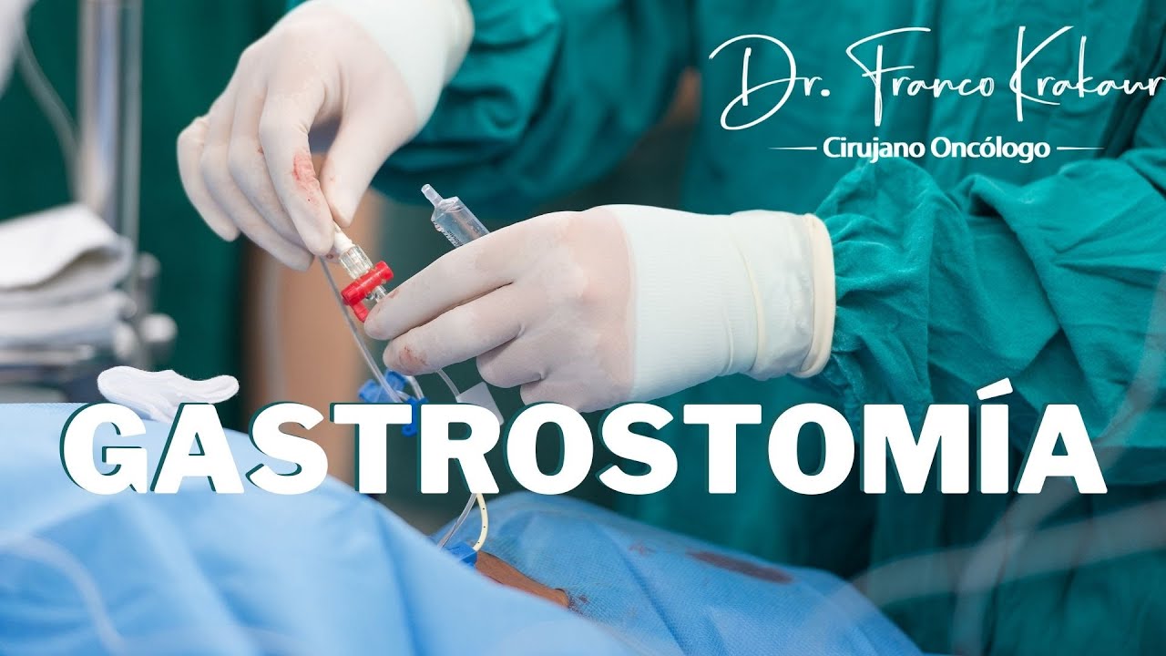 Gastrostom&iacute;a/ Dr. Franco Krakaur/ Cirujano Onc&oacute;logo