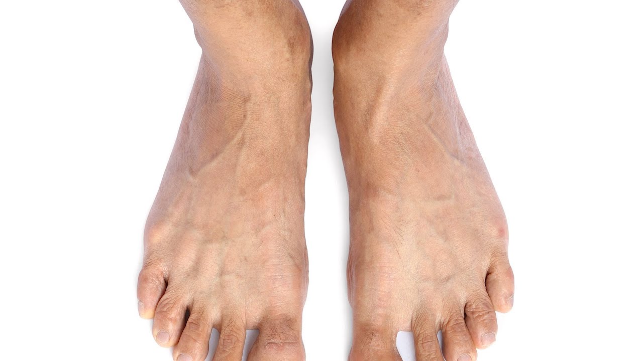 How to Know If You Have Mallet Toes | Foot Care