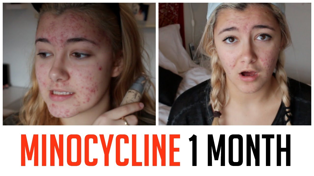 1 MONTH ON MINOCYCLINE UPDATE | HOW I CLEARED MY ACNE