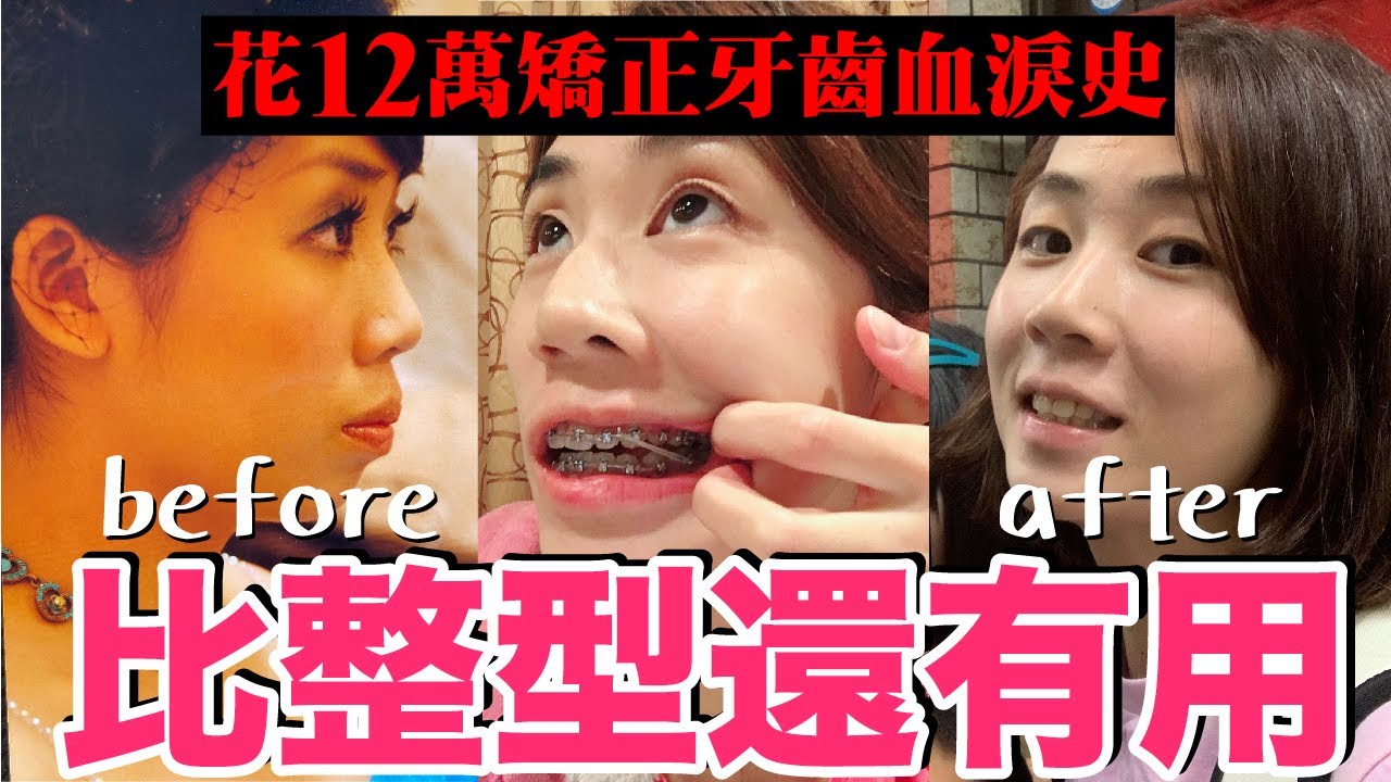 老婆的黑歷史!!花12萬矯正牙齒經驗分享...前後到底差多少呢？