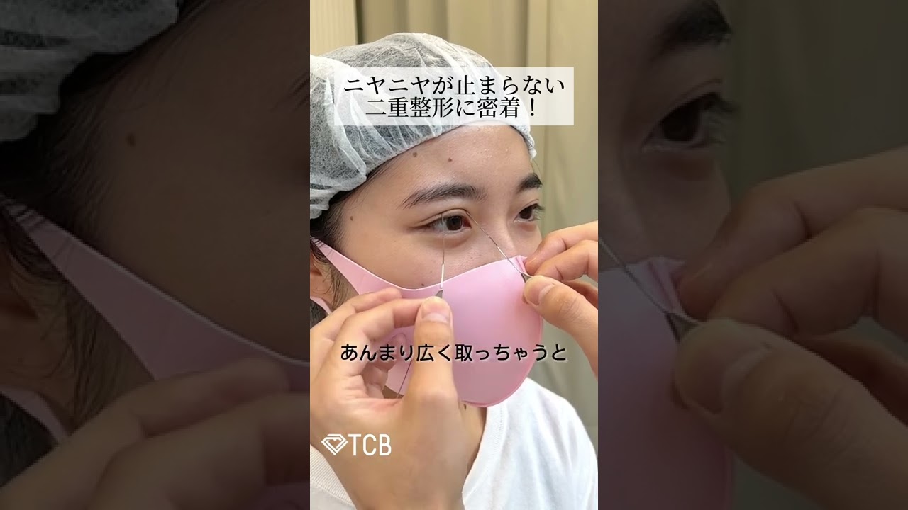 【二重整形】ニヤニヤが止まらない二重整形に密着！#shorts