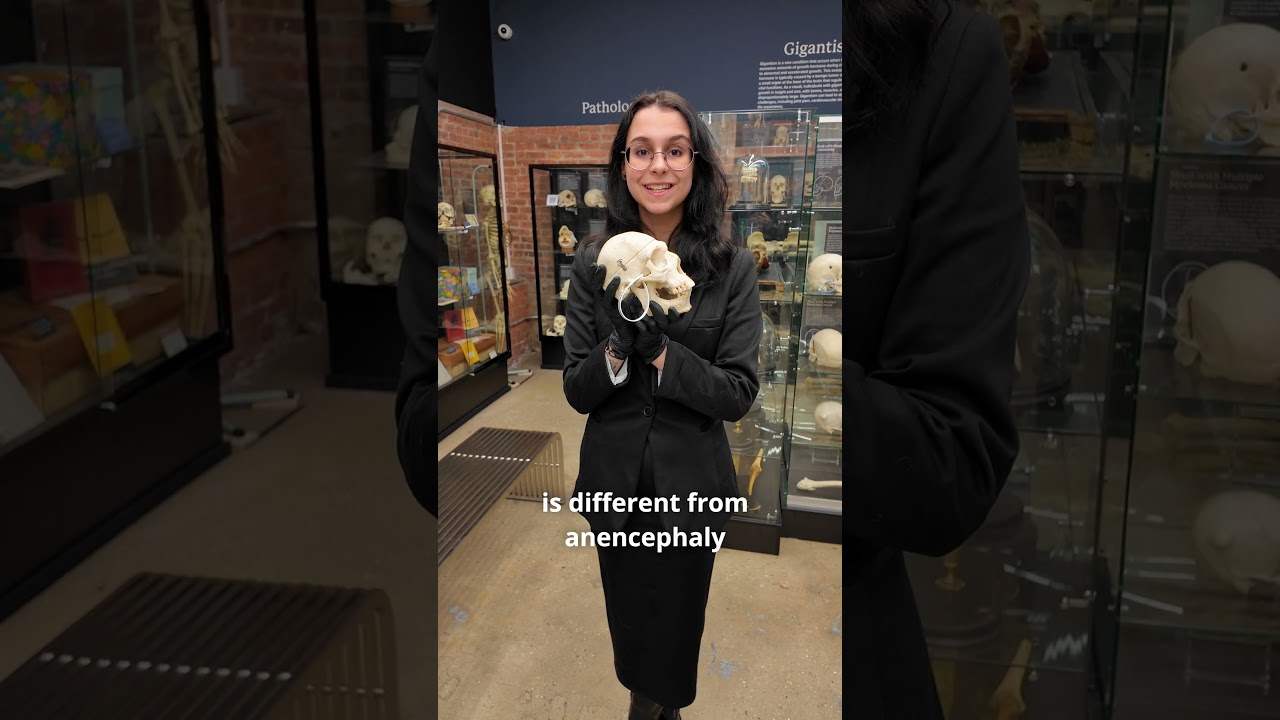 What is Microcephaly?