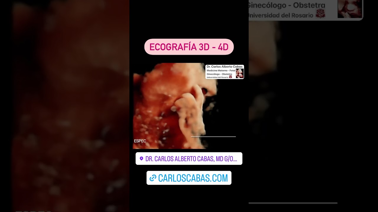 Ecograf&iacute;a 3D - 4D #LoveUltrasound #MedicinaMaternoFetal #Perinatolog&iacute;a #Perinat&oacute;logo #3D #4D