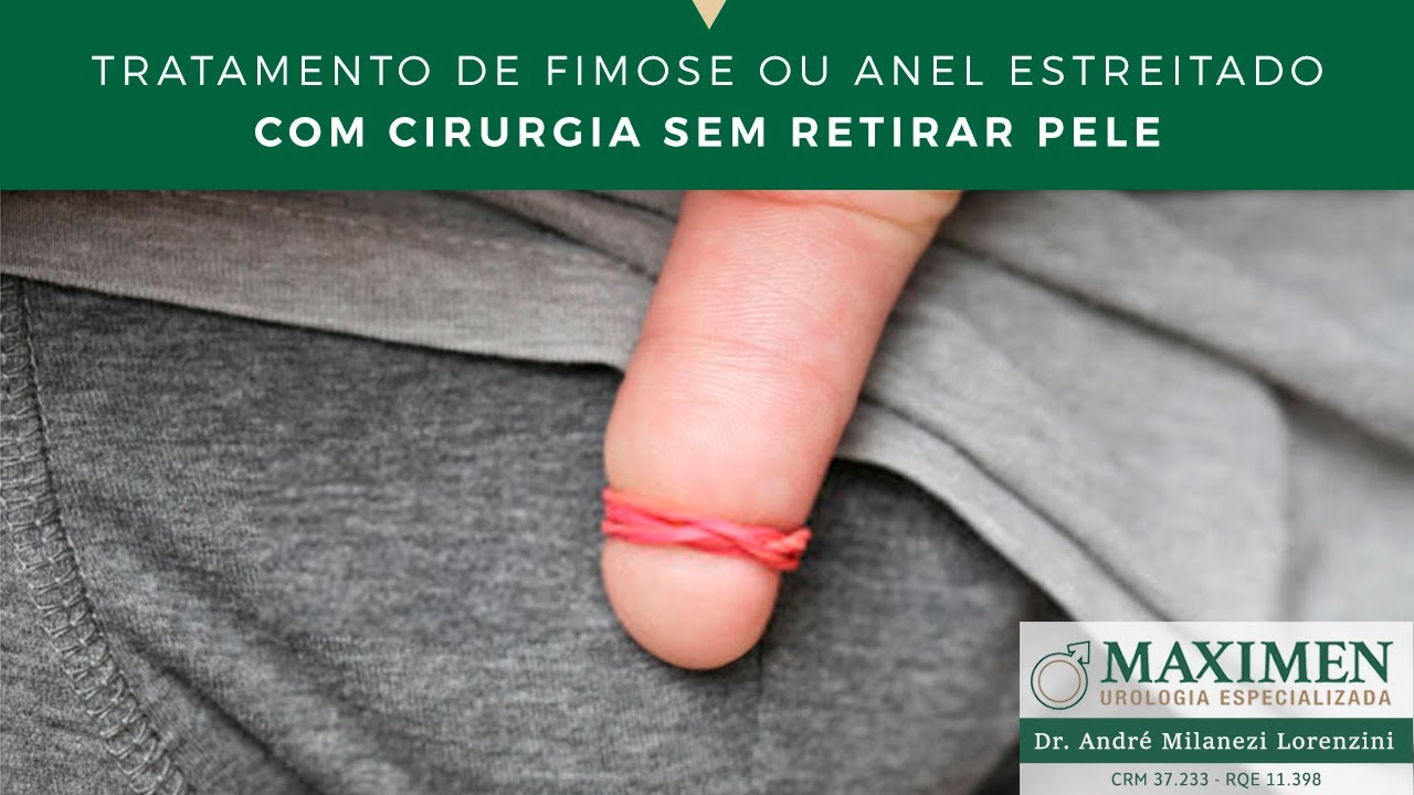 Como tratar fimose ou anel estreitado com cirurgia sem retirar pele?