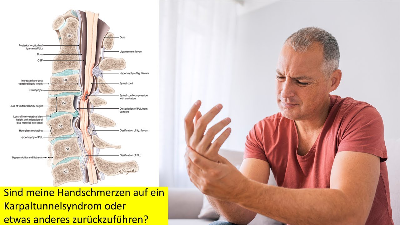 Sind meine Handschmerzen auf ein Karpaltunnelsyndrom oder etwas anderes zur&uuml;ckzuf&uuml;hren