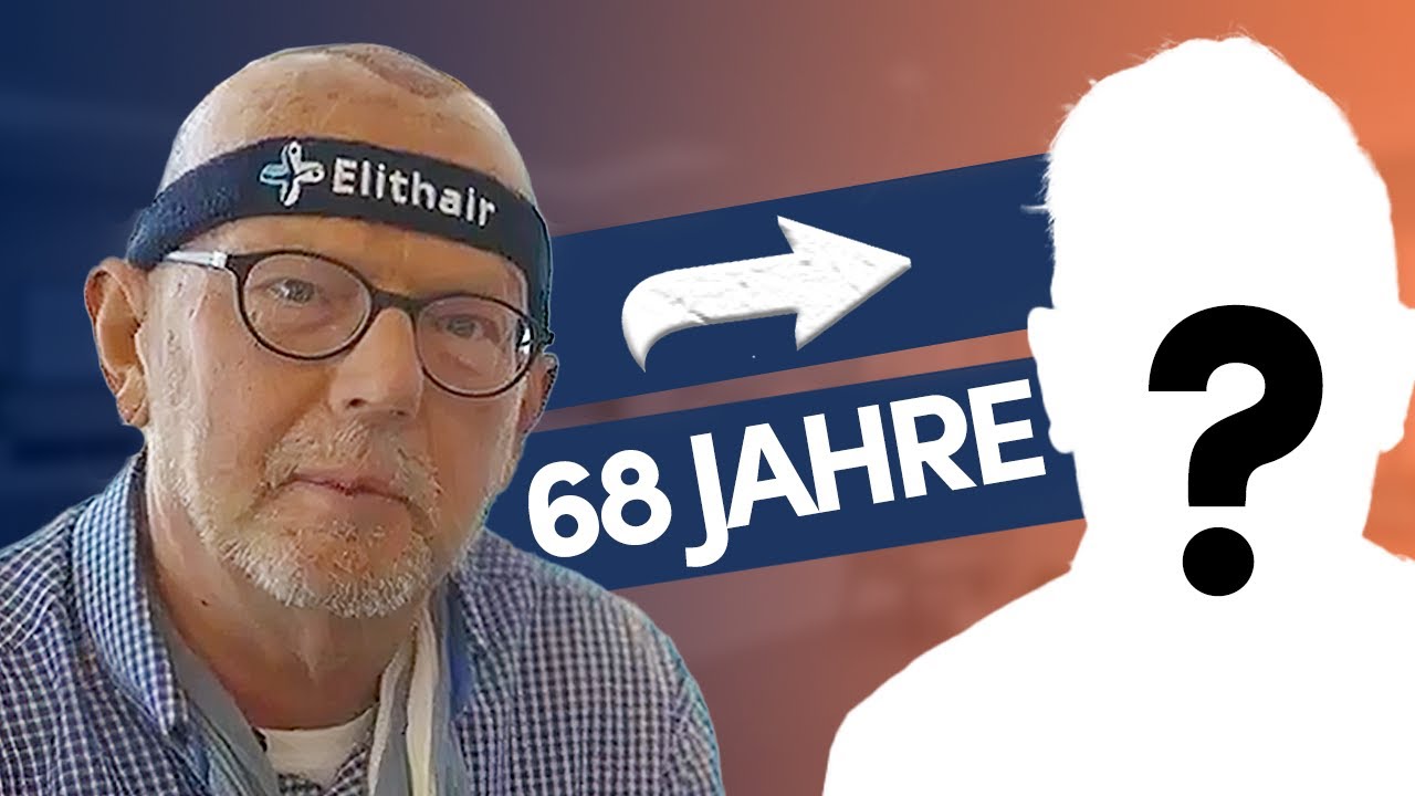 Haartransplantation mit 60+ Jahren | 10 Monate Update