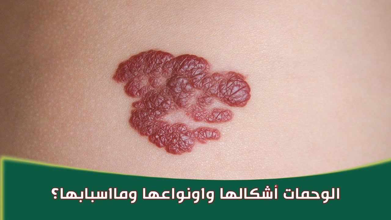 ؟الوحمات أشكالها وأونواعها وماأسبابها