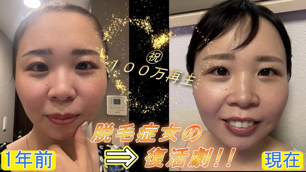 【脱毛症】33歳脱毛症女の復活劇！！脱毛症になって人生初坊主にした動画が１００万再生突破致しました✨