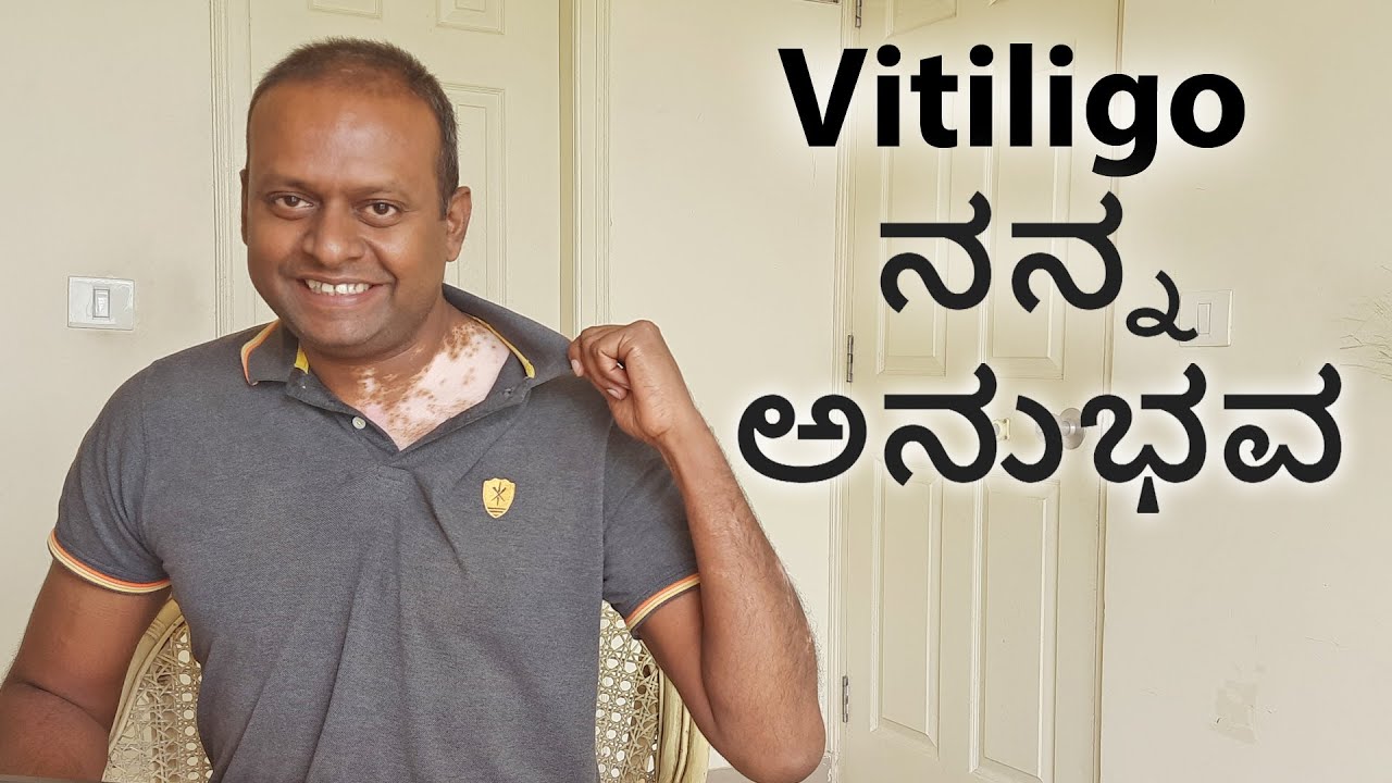 Vitiligo My Experience World Vitiligo Day ವಿಟಿಲ್‍ಗೋ-ತೊನ್ನು ಹಾಲ್ಚರ್ಮ ಬಿಳಿ ಮಚ್ಚೆ