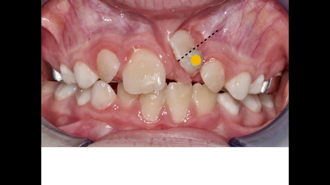 🔥Unexpected orthodontic impaction 🔥
