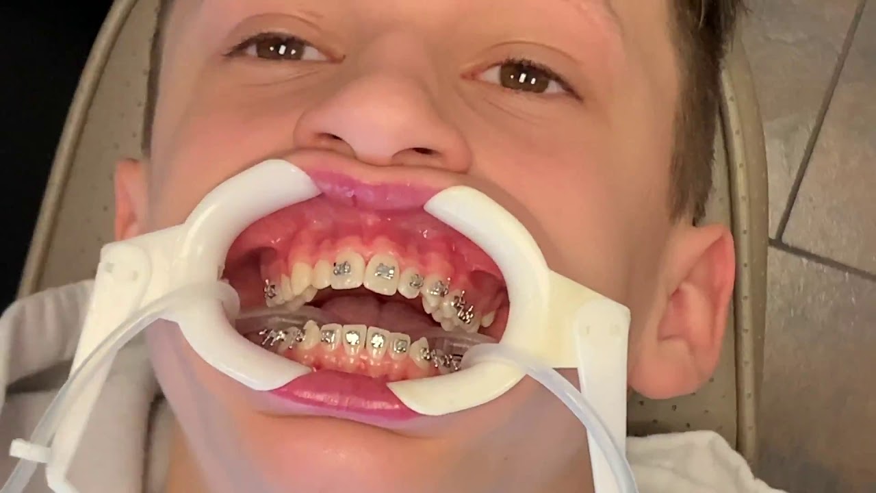 Bridger Gets Braces, Prepping for an Expander