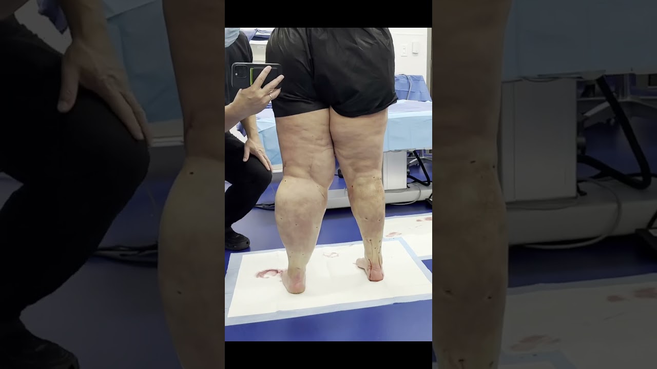 Leg Lipo Results #shorts #lipedema #liposuction #weightloss #beforeandafter #weightlossjourney