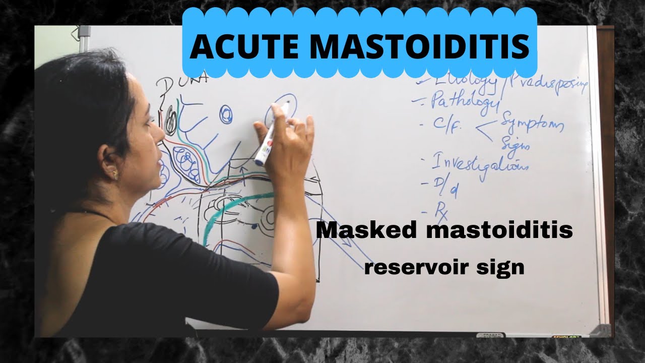 038.Acute and Masked  Mastoiditis  #csom