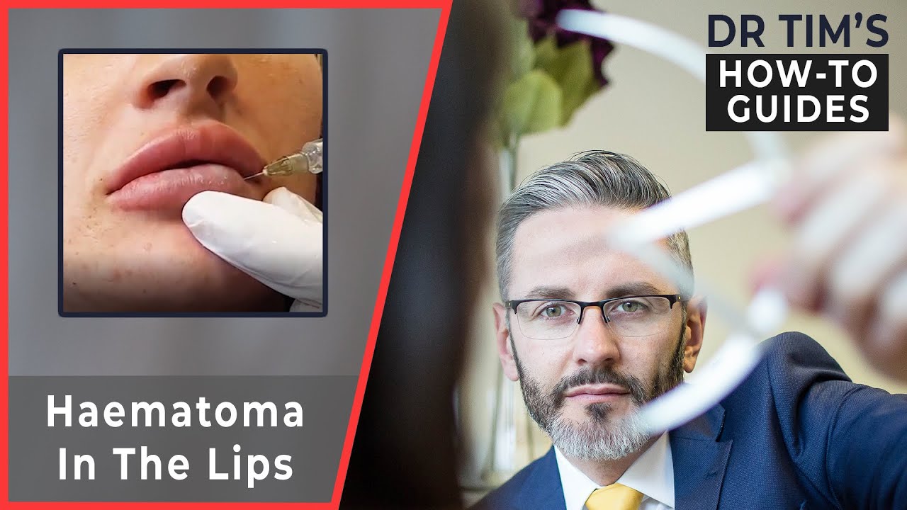 How To Diagnose, Manage & Avoid A Haematoma In The Lips