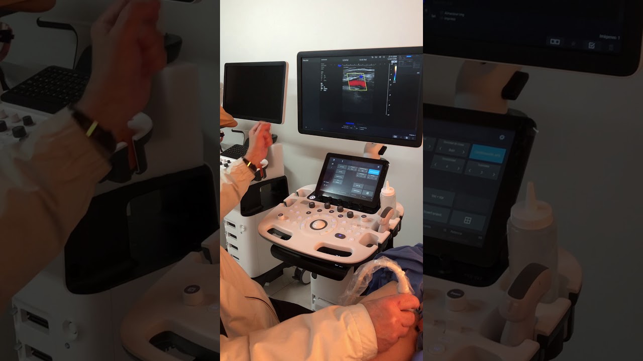 Examen Vascular Venoso en MsIs con Eco-Doppler. HS40 de Samsung.