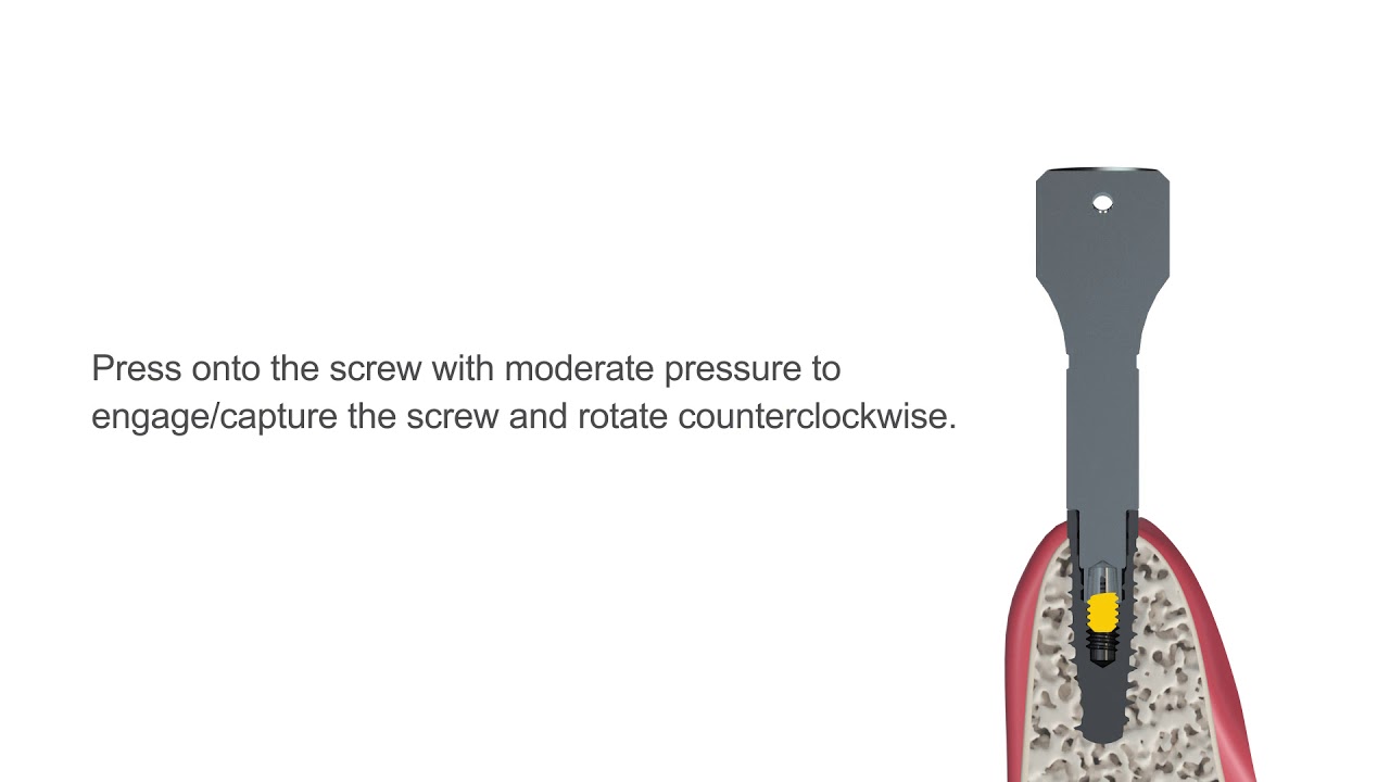 Screw Removal Tool Kit Instructional Video For Certain and External Hex Implants