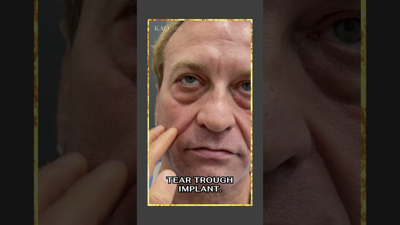 Facelift For Men - Male Ponytail Facelift Pre-op  #beforeandafter #facelift