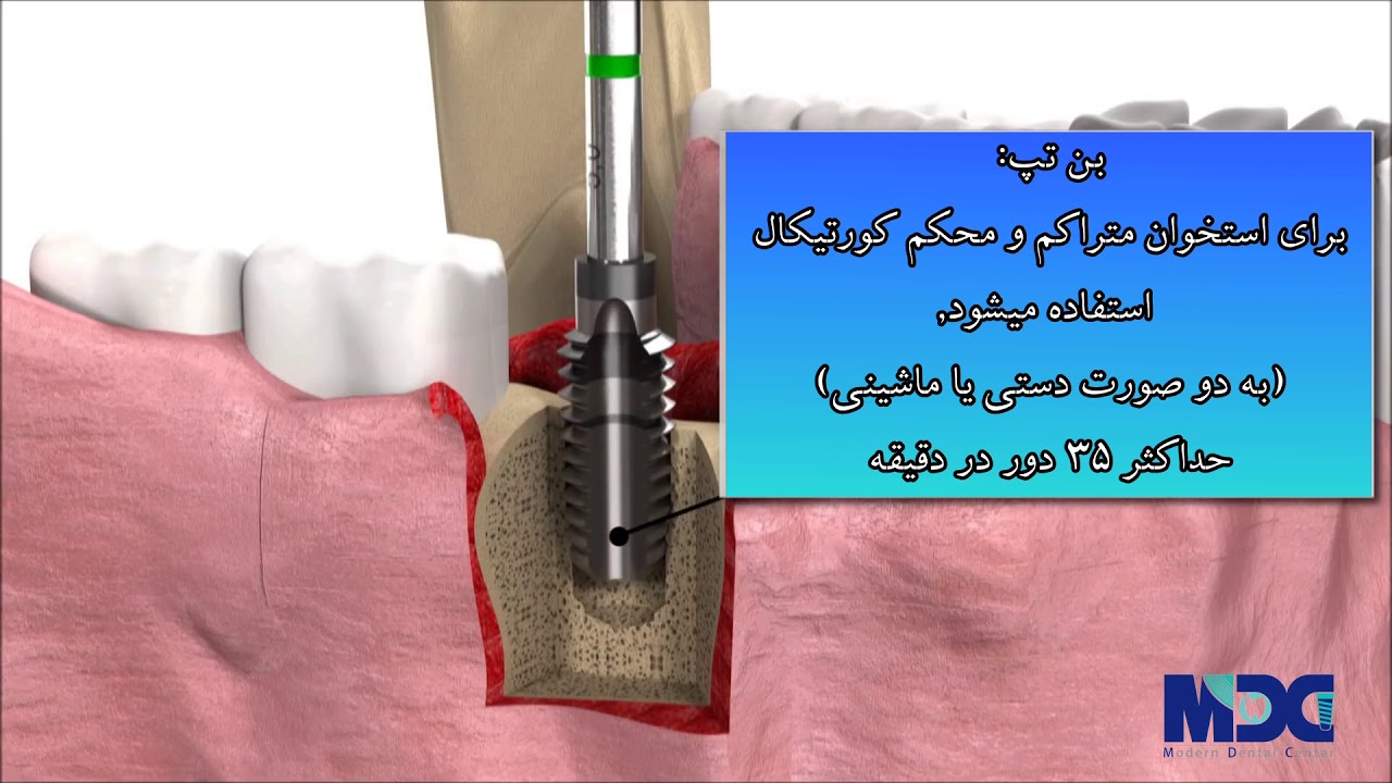 مراحل کاشت ایمپلنت|کلینیک دندانپزشکی مدرن